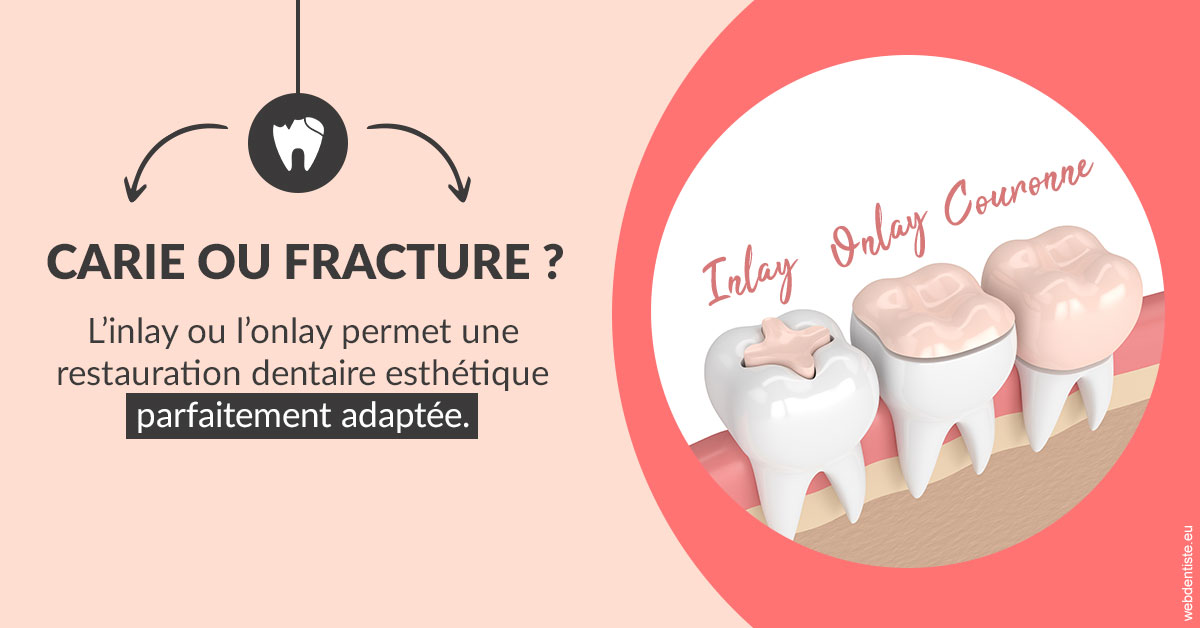 https://dr-christophe-hollebecque.chirurgiens-dentistes.fr/T2 2023 - Carie ou fracture 2