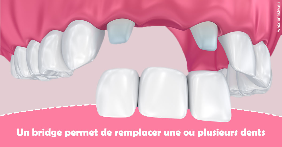 https://dr-christophe-hollebecque.chirurgiens-dentistes.fr/Bridge remplacer dents 2