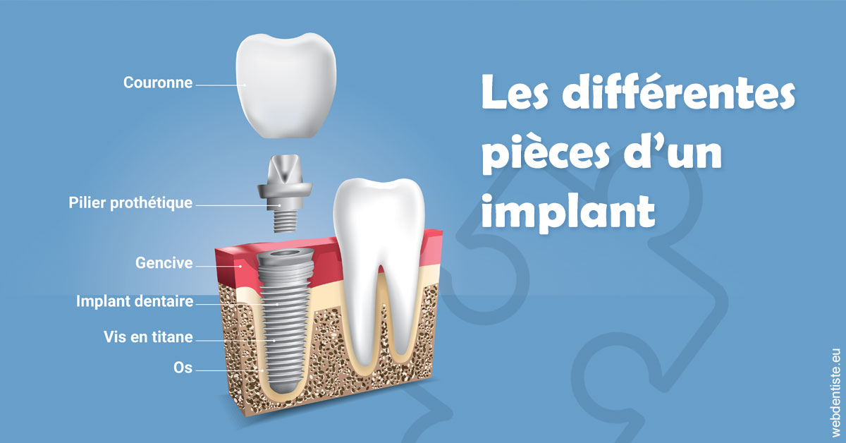 https://dr-christophe-hollebecque.chirurgiens-dentistes.fr/Les différentes pièces d’un implant 1